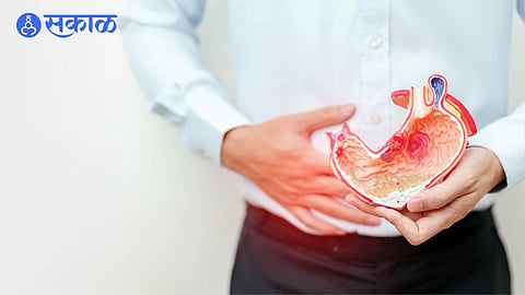 irritable bowel syndrome