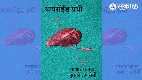 Doctors Perform Complex Surgery to Remove Fish Bone Lodged
