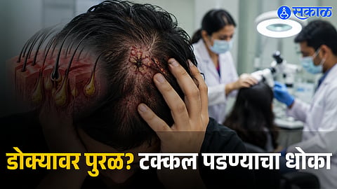 The Danger of Scalp Acne