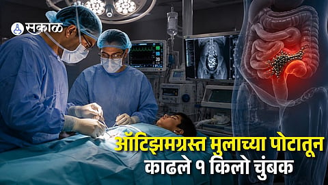 Doctors Remove 1 Kg of Magnets from 10-Year-Old Boy's Stomach, Timely Surgery Saves Life