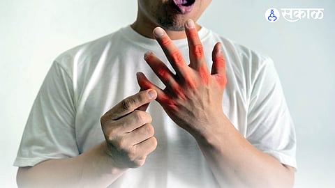 The article explains the Ayurvedic understanding of uric acid (Vatarakta), highlighting the role of digestion, diet, lifestyle changes, Panchakarma, and herbal therapies in managing joint pain, inflammation, and excess body acidity.
