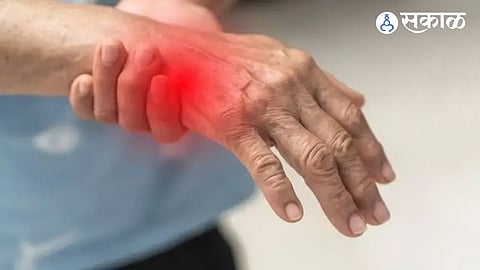 guillain barre syndrome