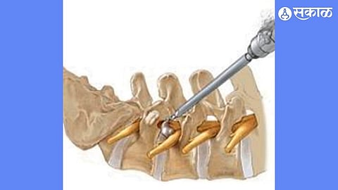 Stitchless Spine Surgery