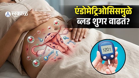 Endometriosis & Insulin Resistance Connection