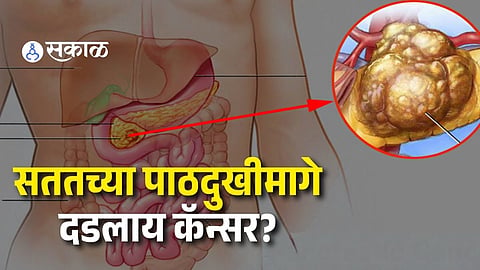 Pancreatic Cancer Symptoms