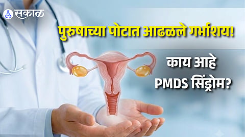 Uterus Found Inside 26-Year-Old Man What Is PMDS Syndrome