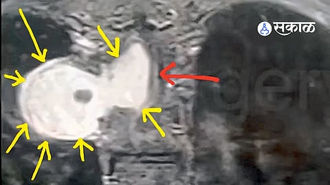 Advanced Neurosurgery for Spinal Tumors: Insights by Dr. Jaydev Panchvagh