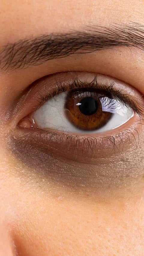 dark Circles Remedies