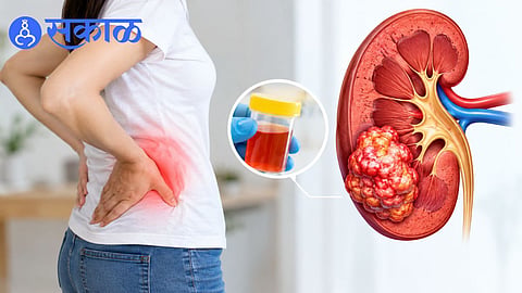 kidney cancer causes and risk factors