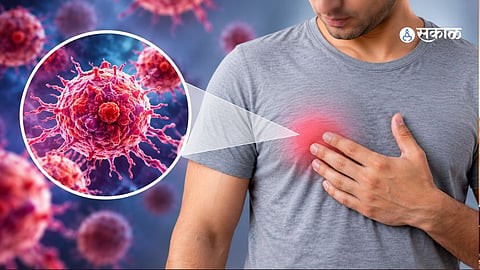 Male Breast Cancer Symptoms