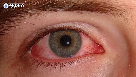 Surge in Conjunctivitis Cases