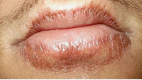 home remedies for dark and chapped lips
