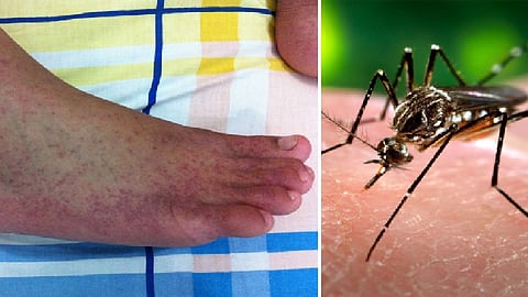 Chikungunya is now added to the corona thaman in Sangli district