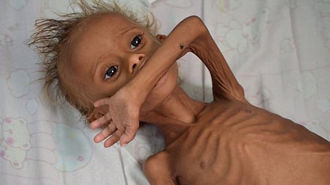881 children on the verge of malnutrition in Sindhudurg
