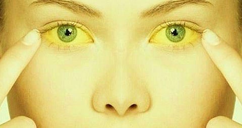 jaundice  images.jpg