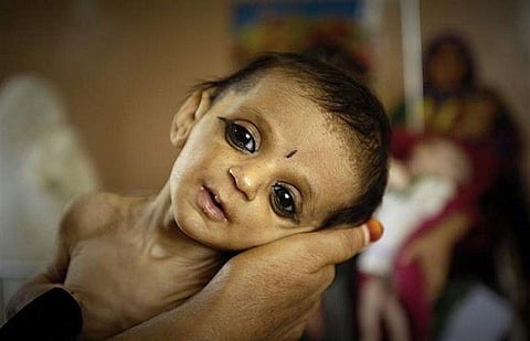 Nine hundred children in the district are in the shadow of malnutrition