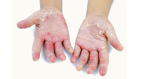 psoriasis