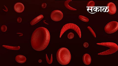 sickle cell patients facing problems in sironcha of gadchiroli