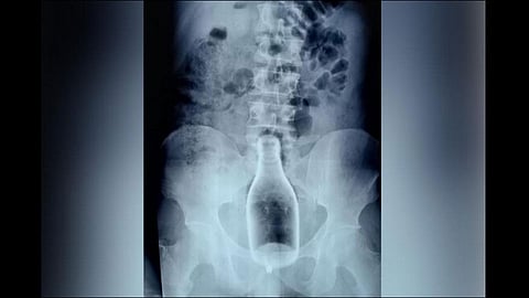 drunk man inserts glass bottle into body through anus, surgically removed in tn