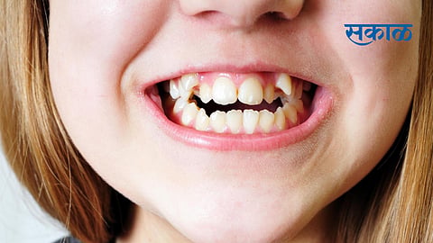 crooked teeth people should avoid some food