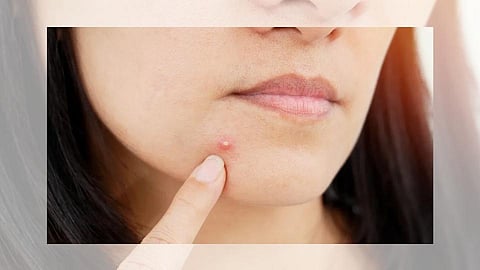 #PCOS : चेहऱ्यावर पुरळ येतंय?  जाणून घ्या पीसीओएसची लक्षणं