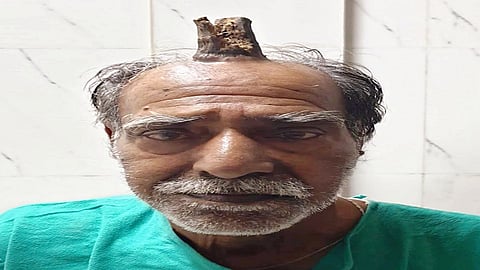 श्यामलाल यादव यांच्या डोक्यावर शिंग उगवले आहे