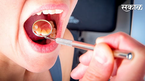 You may have these diseases if having problem of bleeding gums 