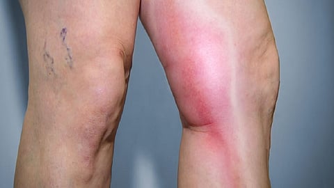 Deep Vein Thrombosis