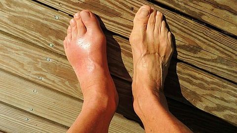 Gout 