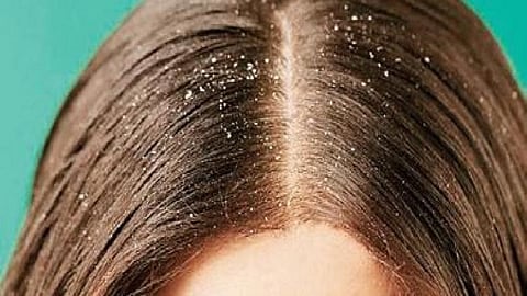 here are the remedies for dandruff in hairs read full story  