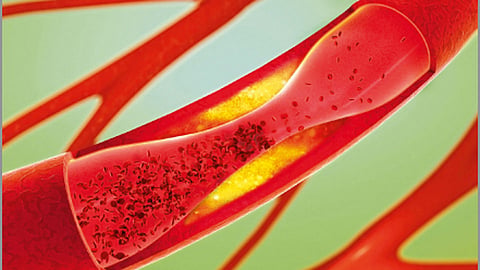 cholesterol