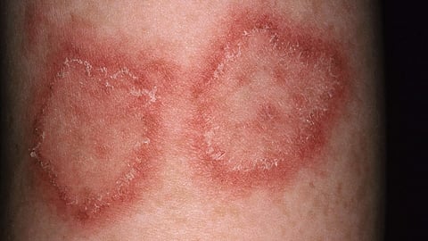 Avoid steroids for skin infections 