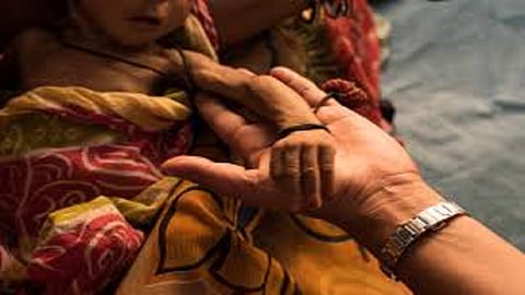 33 Pediatricians will adopt 54 malnutrition children in chandrapur   