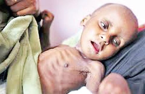 The highest number of malnourished people in Belgaum district