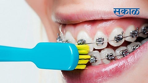 Nagpur news Many problems can occur if the teeth are not brushed