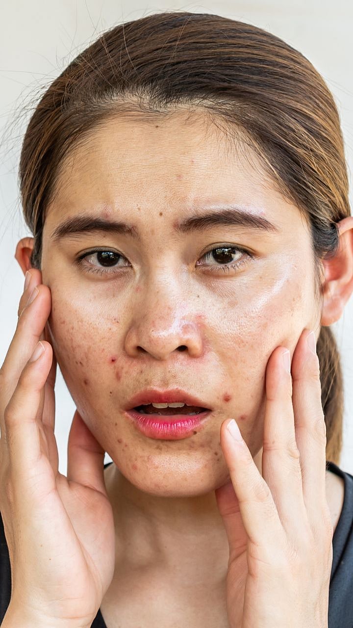चेहऱ्यावर जास्त तेल येते? पावसाळ्यात फॉलो करा 'या' स्किनकेअर टिप्स