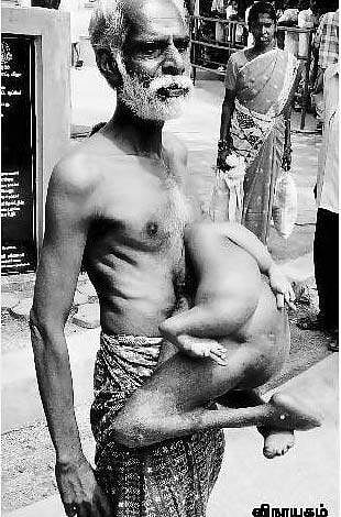 54 ஆண்டுகளாக வயிற்றில் கை, கால்களுடன் அதிசய மனிதர்﻿: மருத்துவ சிகிச்சை கோரி ஆட்சியரிடம் மனு﻿