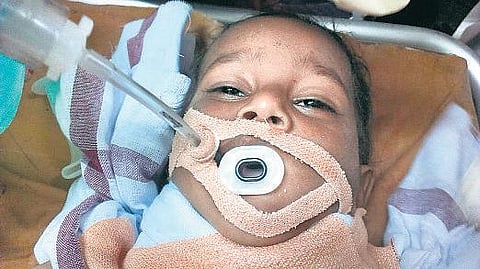 விபத்தில் சிக்கி உயிருக்கு போராடிய குழந்தையை 25 டாக்டர்கள் 8 மணி நேரம் போராடி காப்பாற்றினர்﻿: எழும்பூர் அரசு குழந்தைகள் நல மருத்துவமனை சாதனை﻿
