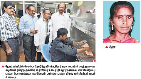 அரசு ஸ்டான்லி மருத்துவமனையில் தோல் வங்கி தொடங்கிய சில நாட்களிலேயே 2 பேர் தானம்