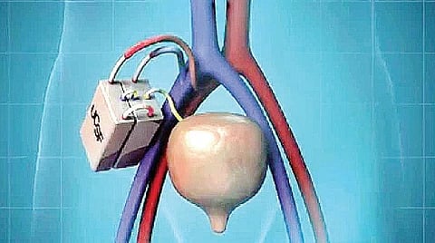 வருகிறது செயற்கைச் சிறுநீரகம்!