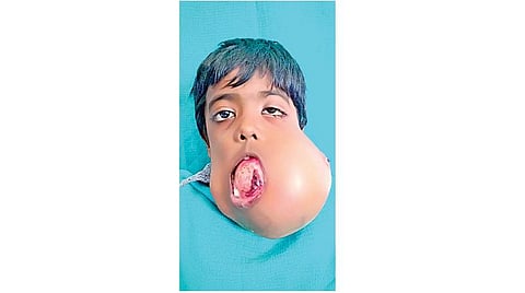 இந்தியாவில் முதல் முறையாக அறுவை சிகிச்சை மூலம் 7 வயது சிறுவனின் தாடையில் இருந்த 1.5 கிலோ கட்டி அகற்றம்:  சென்னை அரசு பல் மருத்துவமனை சாதனை