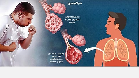 மருத்துவம் தெளிவோம்! 20: சுவாசம் சுருங்கும் பிரச்சினைகள்!