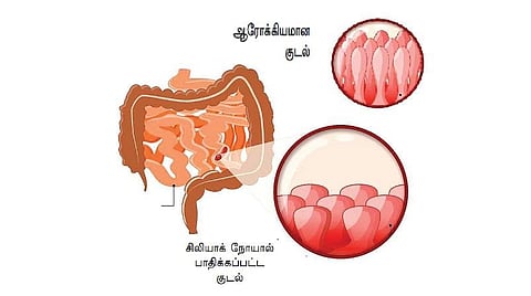 மருத்துவம் தெளிவோம் 27: குடலே நலமா?