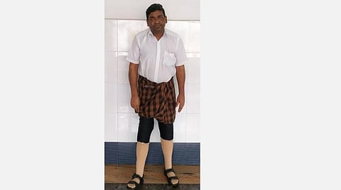 சர்க்கரை நோயால் இரு கால்களையும் இழந்தவர்; கோவை அரசு மருத்துவமனையில் எடை குறைந்த செயற்கைக் கால்கள் பொருத்தம்