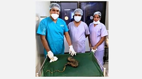 வயிற்றிலிருந்து அகற்றப்பட்ட முடிகட்டியுடன் மருத்துவர் ராஜமகேந்திரன் மற்றும் செவிலியர்கள்.