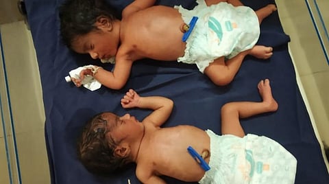 சிவகங்கை அரசு மருத்துவமனையில் பிறந்த இரட்டை குழந்தைகள்.