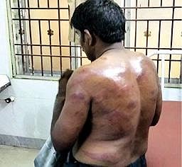 விருத்தாசலம் அரசு மருத்துவ மனையில் சிகிச்சை பெறும் அந்தோணிடேவிட்.