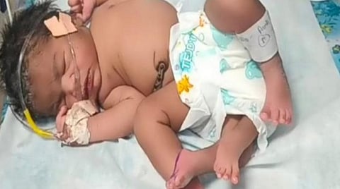 மத்தியப் பிரதேசத்தில் 4 கால்களுடன் பிறந்த பெண் குழந்தை