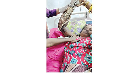 சென்னை ராஜீவ்காந்தி அரசு மருத்துவமனையில் சிகிச்சை பெற்றுவரும் ஜோதி.