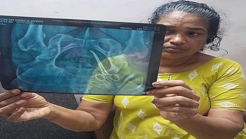 பெண் வயிற்றில் கத்திரிக்கோல்: 5 ஆண்டுக்குப் பின் கண்டுபிடிப்பு